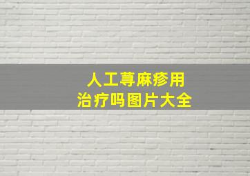 人工荨麻疹用治疗吗图片大全