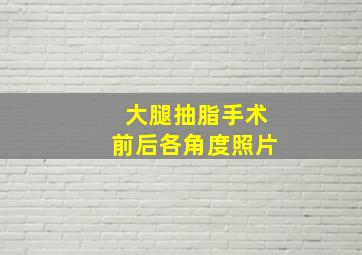 大腿抽脂手术前后各角度照片