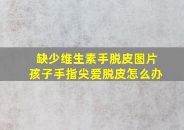 缺少维生素手脱皮图片孩子手指尖爱脱皮怎么办